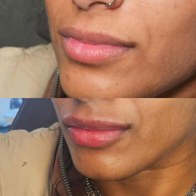 Before and After Photos of ABC Health and Beauty in Frisco, TX