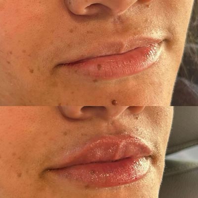 Before and After Photos of ABC Health and Beauty in Frisco, TX