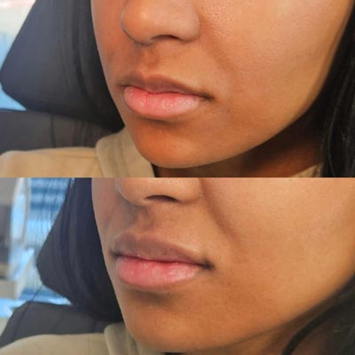 Before and After Photos of ABC Health and Beauty in Frisco, TX