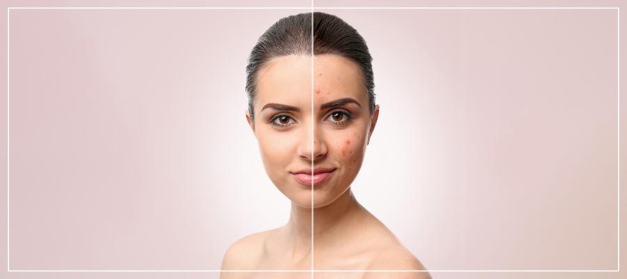 Acne Facial Treatment Specialist Near Me in Frisco, TX