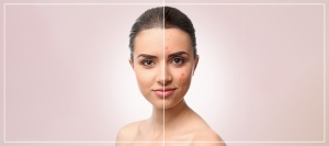 Acne Facial Treatment Specialist Near Me in Frisco, TX