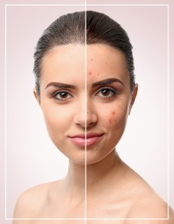 Acne Facial Near Me in Frisco, TX Acne Facial Near Me in Frisco, TX