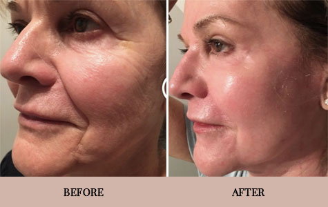 Laser Skin Resurfacing in Frisco, TX