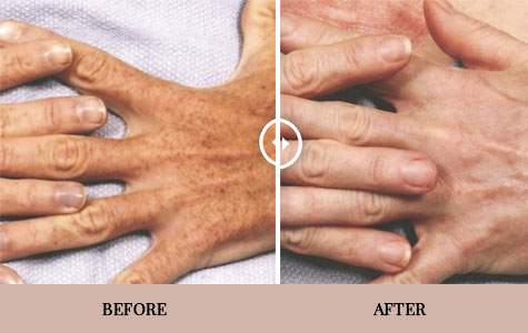 Laser Skin Resurfacing in Frisco, TX