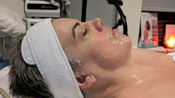 FORMA Treatment Before and After Photos of ABC Health and Beauty in Frisco, TX